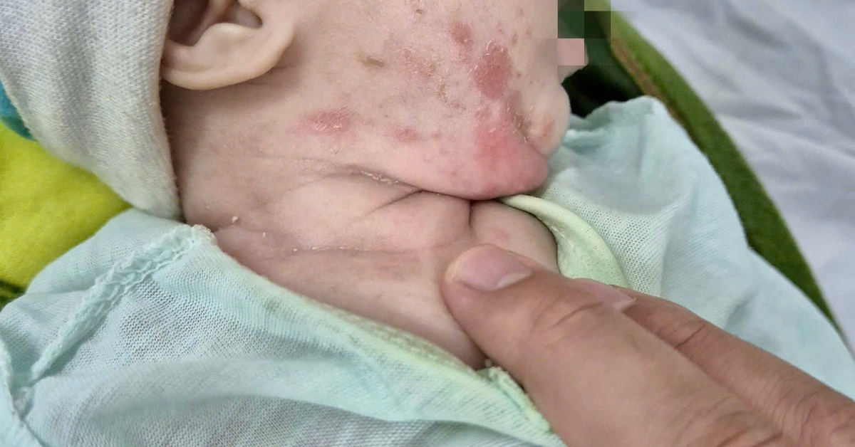 Bé 2 tháng tuổi mắc giang mai lây từ mẹ, bác sĩ nói phòng tránh được - Tuổi Trẻ Online