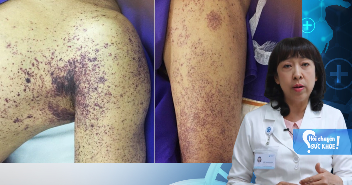 Coi chừng nhiễm liên cầu lợn vì thói quen ăn tiết canh, thịt tái