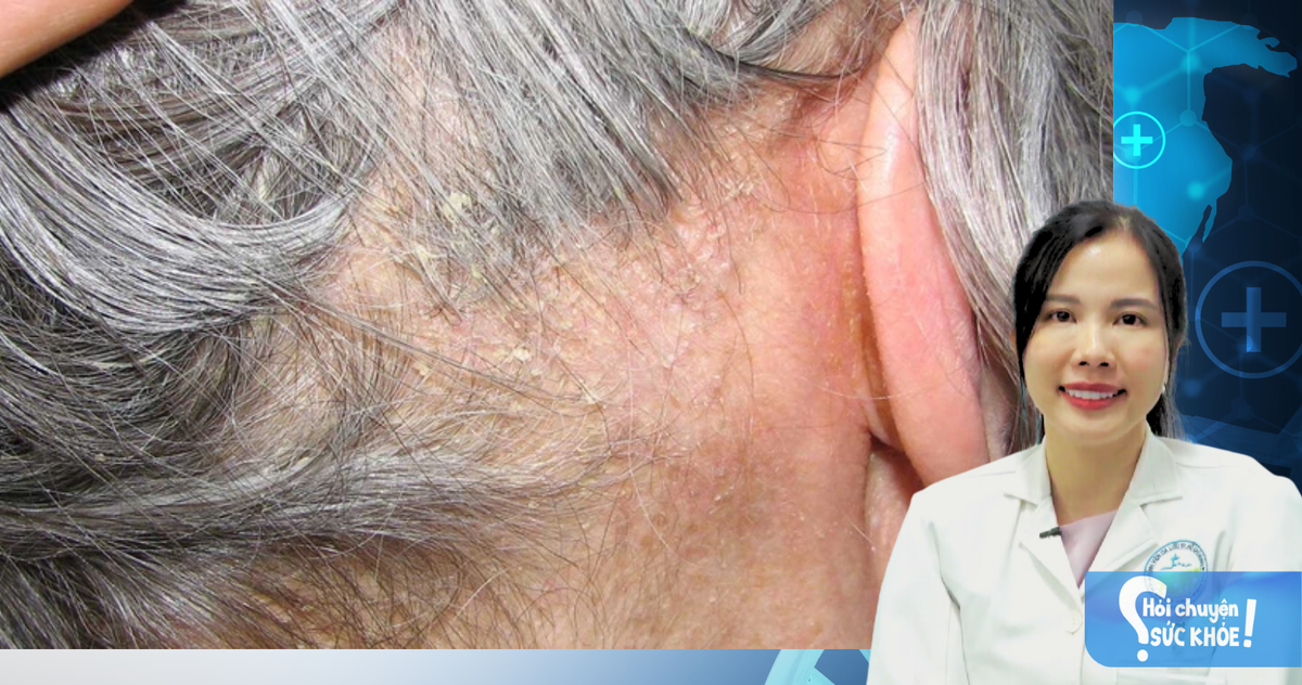 Viêm da tiết bã ở trẻ em khác gì ở người lớn?