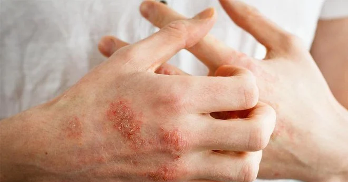 Nổi mụn nước, ngứa dữ dội về đêm… khả năng do ghẻ cái