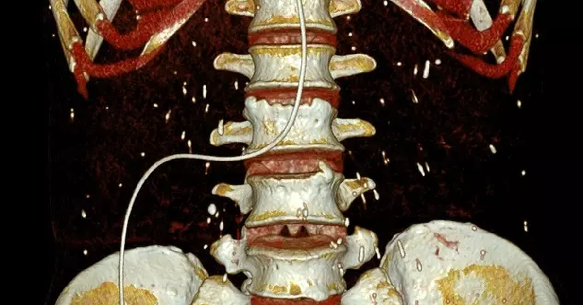 Chụp CT, tá hỏa phát hiện sán rải rác khắp cơ thể người bệnh
