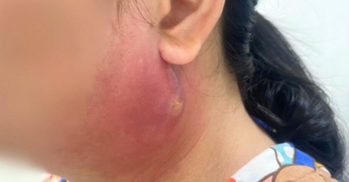 Chủ quan với mụn nhọt, tự ý điều trị tại nhà dẫn đến nguy hiểm tính mạng