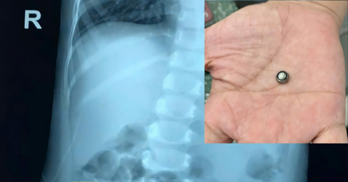 Bé gái 37 tháng tuổi nhập viện do nuốt pin trong đồ chơi điện tử - Tuổi Trẻ Online