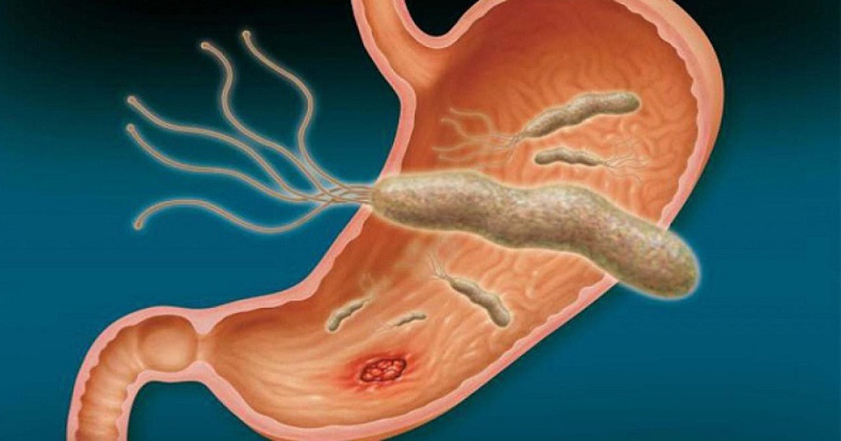 Vì sao vi khuẩn HP lại tăng nguy cơ gây ung thư dạ dày, phòng ngừa thế nào?  - Tuổi Trẻ Online