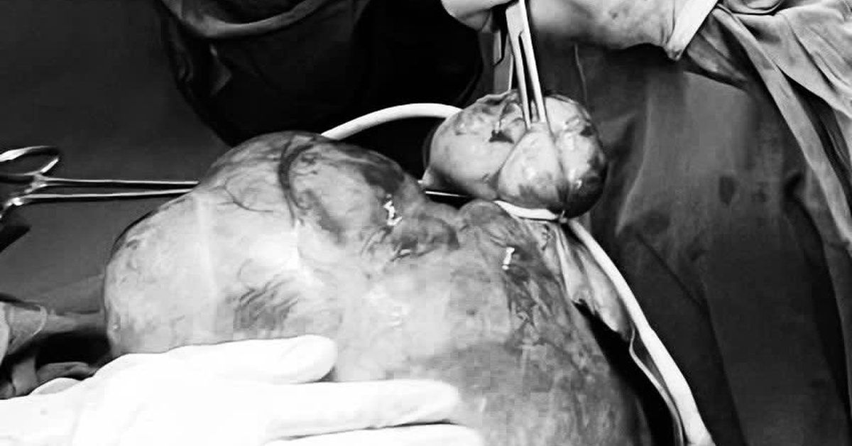 Bệnh viện Đa khoa Thủ Đức cắt thành công khối u xơ tử cung 4,5kg