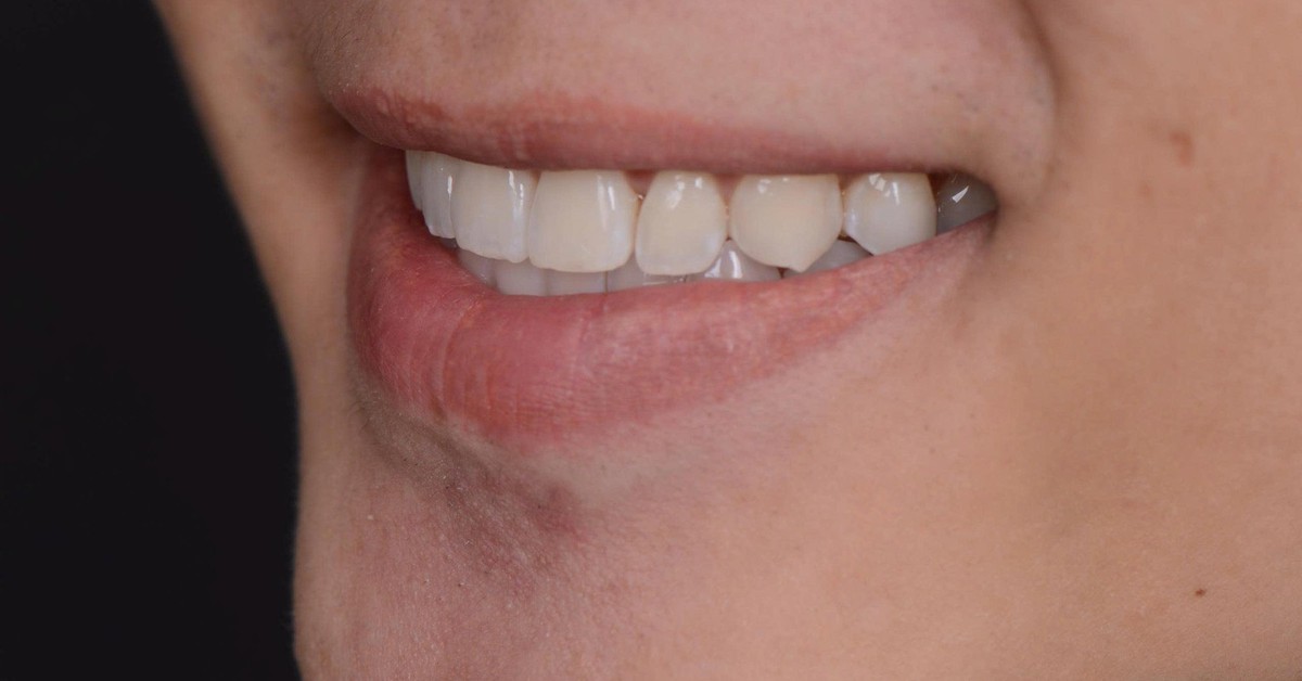 Bác sĩ hướng dẫn người niềng răng vệ sinh khay niềng sạch bóng tại nhà