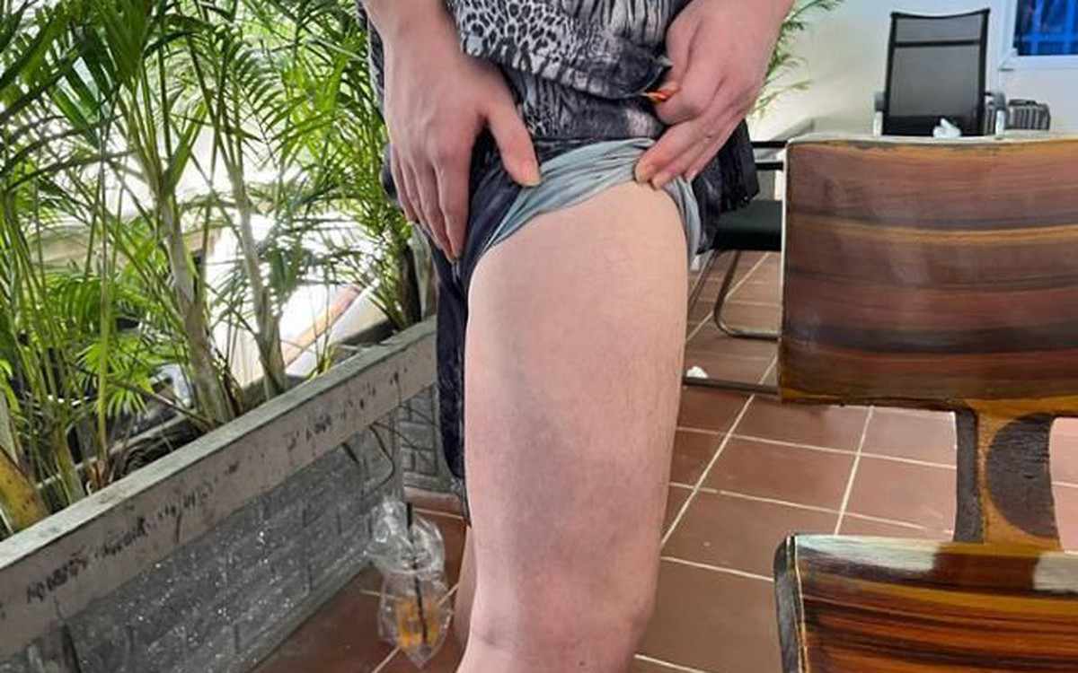 Người Hàn thoát khỏi khu lừa đảo ở Campuchia kể lại: Bị đánh bằng ống sắt, chích điện, như nô lệ