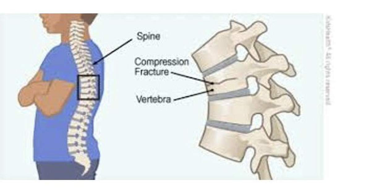 Loãng xương - căn bệnh bị xem nhẹ nhưng tỉ lệ tử vong cao
