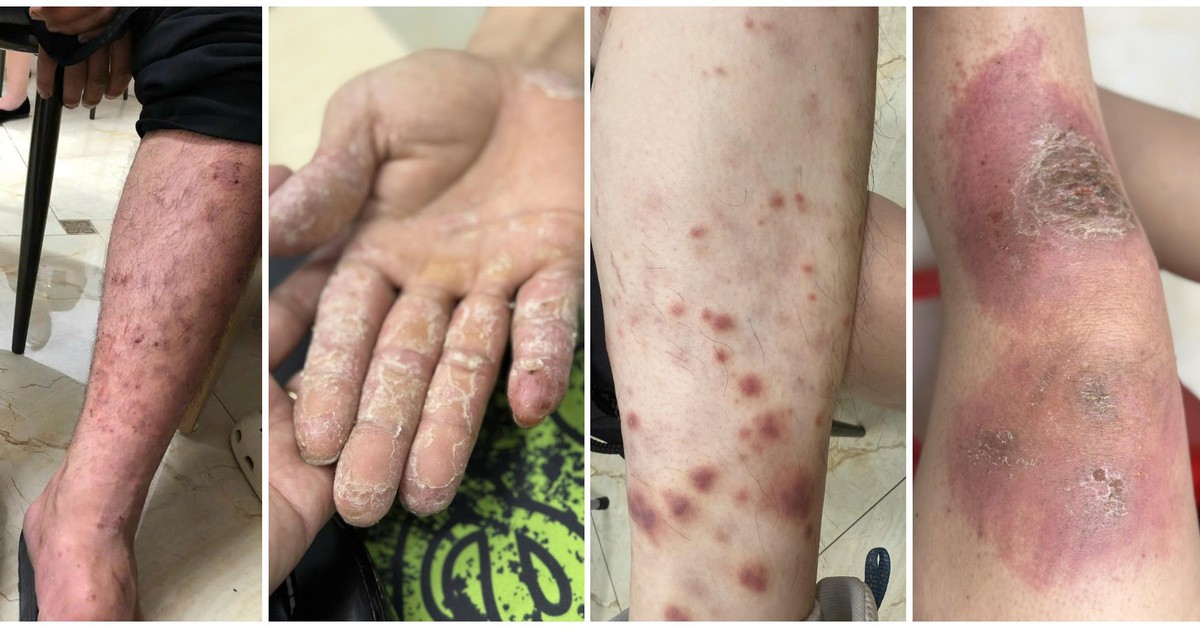 5 bệnh da liễu thường gặp trong mùa mưa lũ và cách xử lý