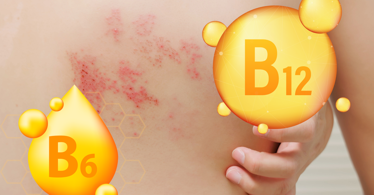 Có thể chăm sóc và hỗ trợ chữa trị người bệnh zona thần kinh bằng thực phẩm?