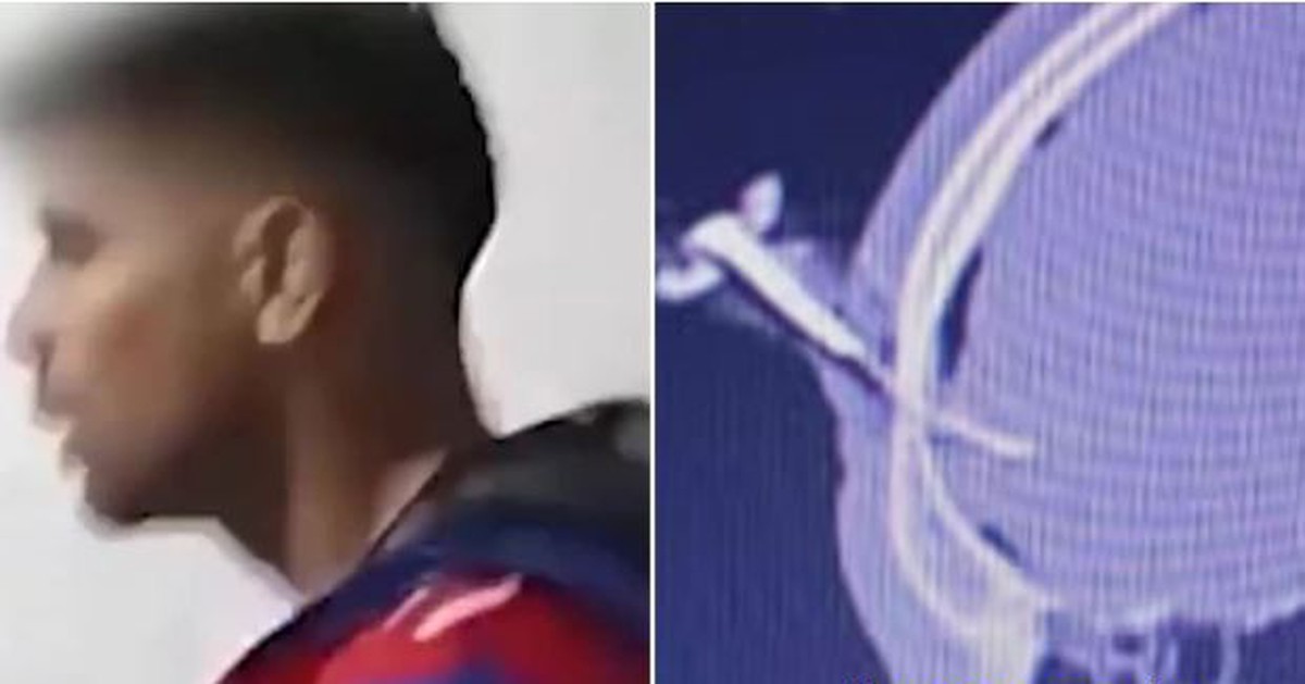 Cầu thủ Argentina nhập viện vì bị đâm chìa khóa xe xuyên qua hộp sọ