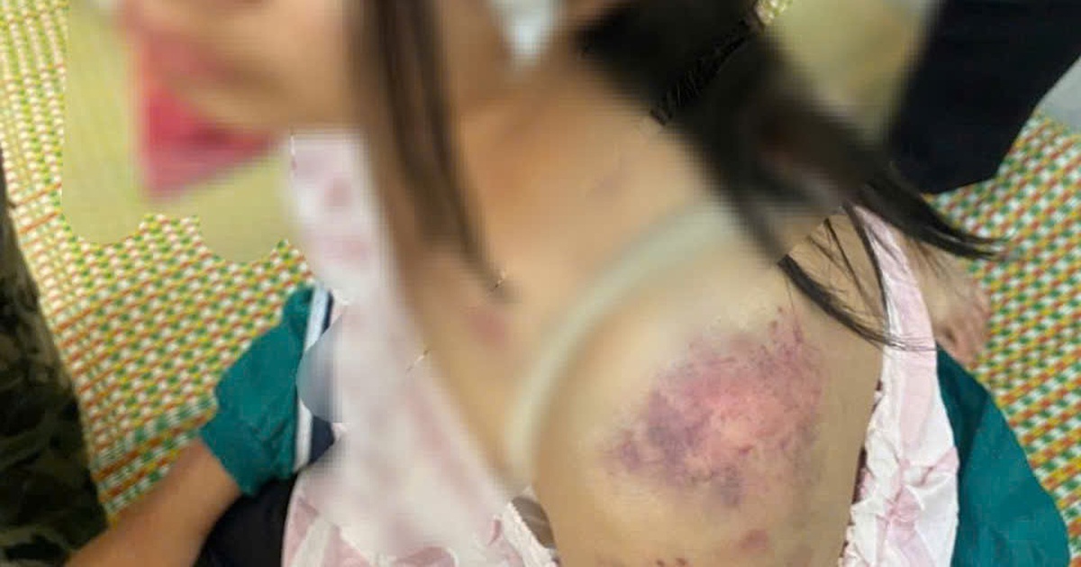 Cục Bà mẹ và Trẻ em chỉ đạo điều trị tâm lý cho bé gái bị 3 người thân bạo hành