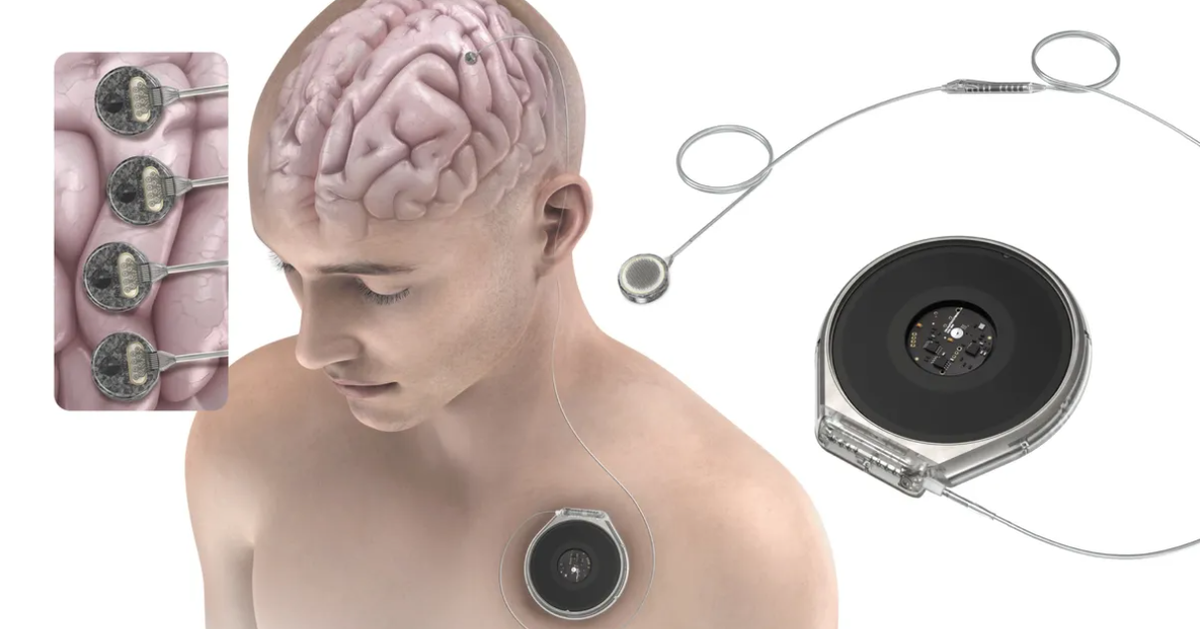 Đối thủ của Neuralink được thử nghiệm cấy chip vào não người