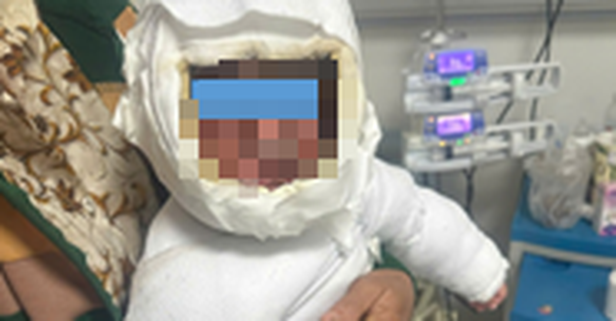 Bé 9 tháng tuổi bỏng 30% cơ thể vì kéo dây điện ấm siêu tốc