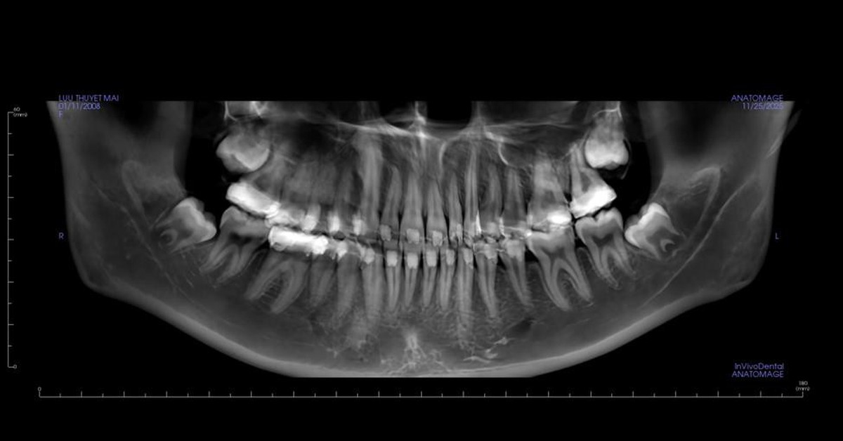 Bác sĩ hướng dẫn tránh sai lầm sau nhổ răng khôn - 'vị khách' đến muộn nhiều phiền toái