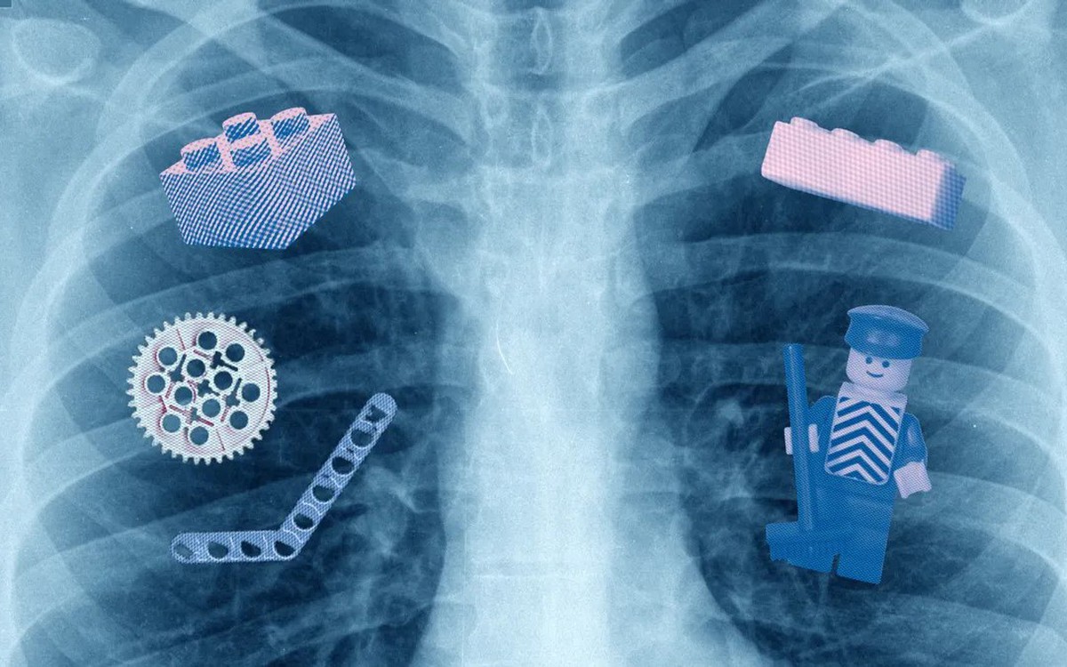 Đồ chơi Lego được trộn thêm chất để phát hiện trẻ nuốt phải khi chụp X-quang?