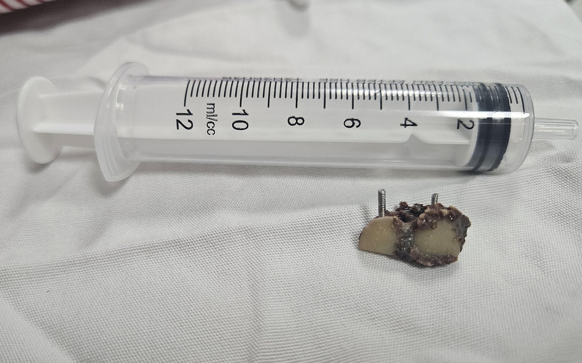 Bỗng dưng mất 2 chiếc răng, 20 năm sau bác sĩ phát hiện trong... phổi