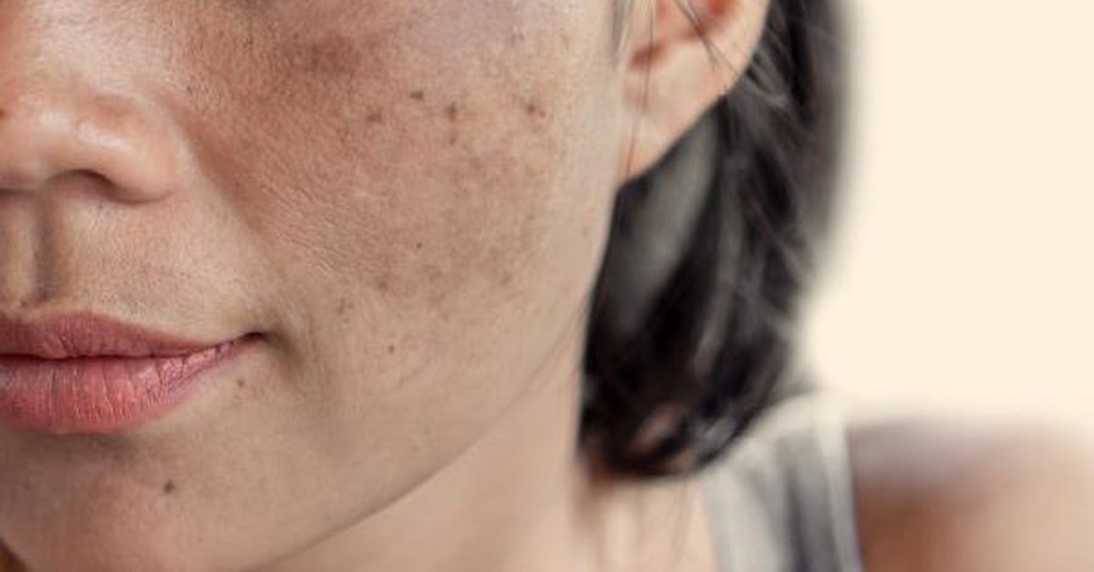 Vì sao da người Việt dễ sạm nám?