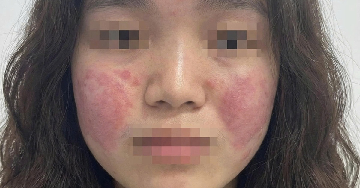 Cô gái trẻ đỏ rát mặt vì ô nhiễm không khí, bác sĩ hướng dẫn cách bảo vệ da