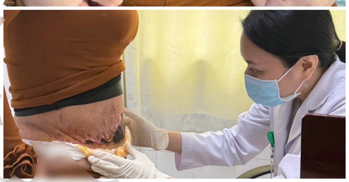 Nám đen, hoại tử da sau phẫu thuật hút mỡ bụng tại spa