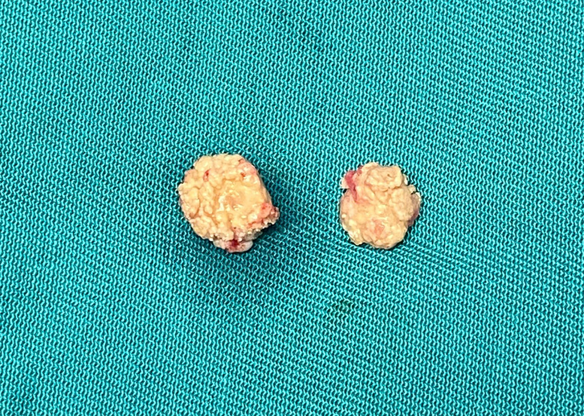 Không chỉ thận, gan, mật, tuyến nước bọt cũng có thể hình thành sỏi