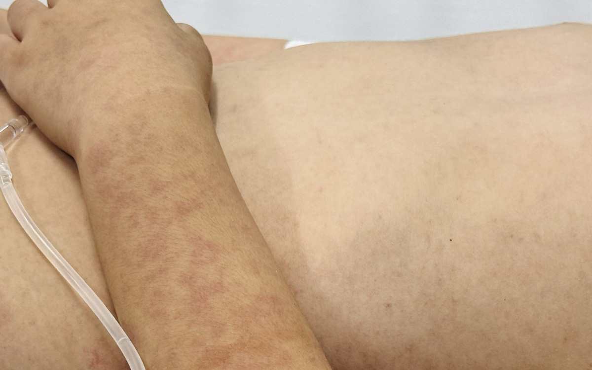 Bệnh sởi tại nhiều tỉnh tăng và kéo dài: Do thiếu vắc xin hay do địa phương bỏ sót?