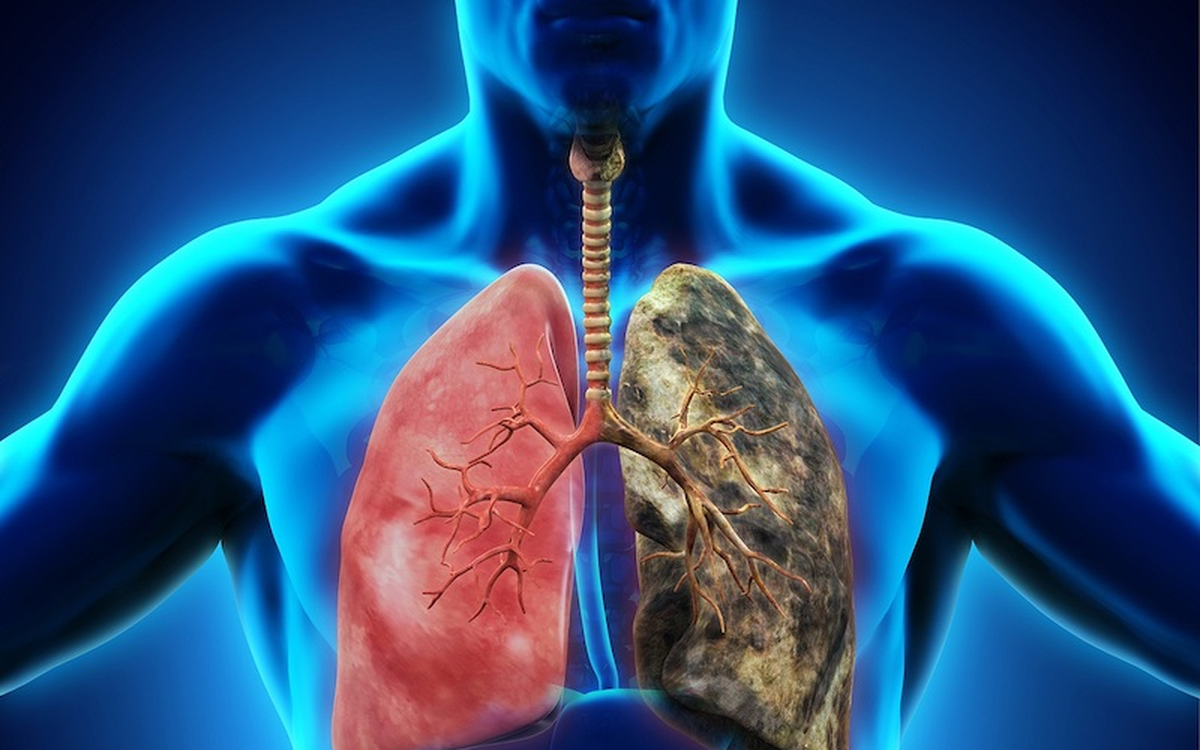 'Giải mã' 5 hiểu lầm phổ biến về ung thư phổi, nhiều người Việt mắc phải