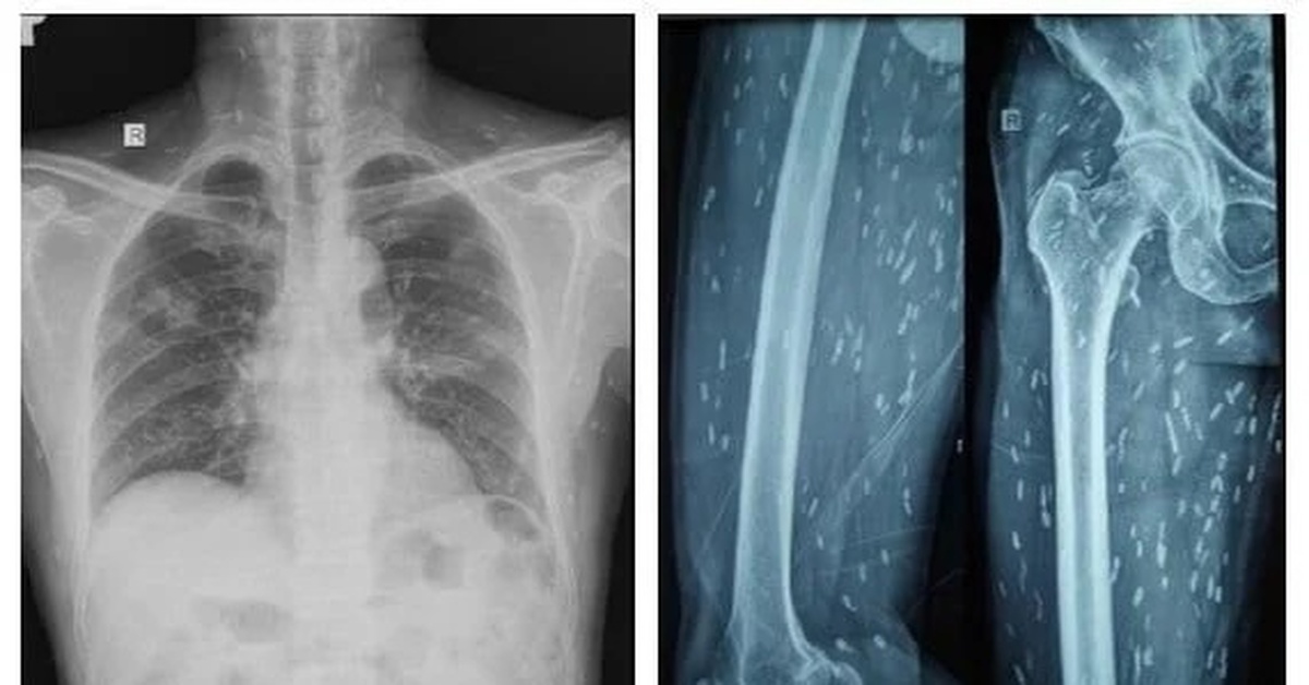 Co giật, yếu nửa người vì sán "làm tổ" trong não do thói quen hay ăn thịt tái