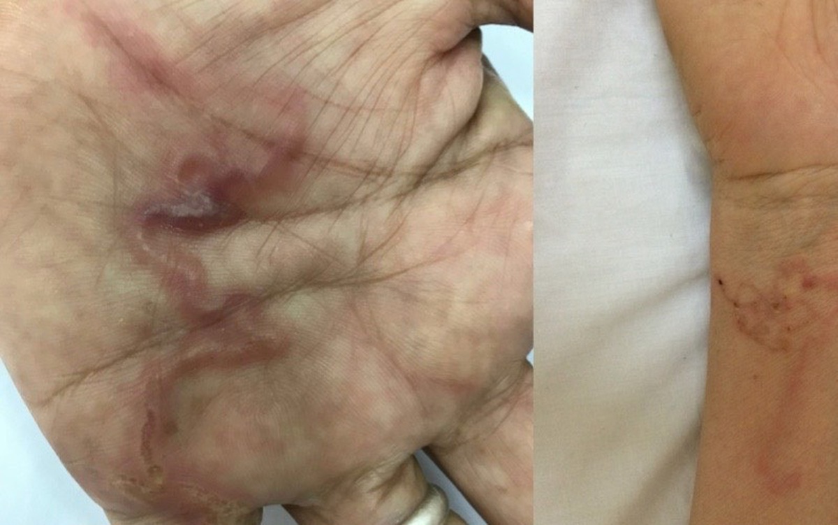 Ghi nhận ca bệnh 'giun rồng' ở Việt Nam, loại giun dài đến hàng mét