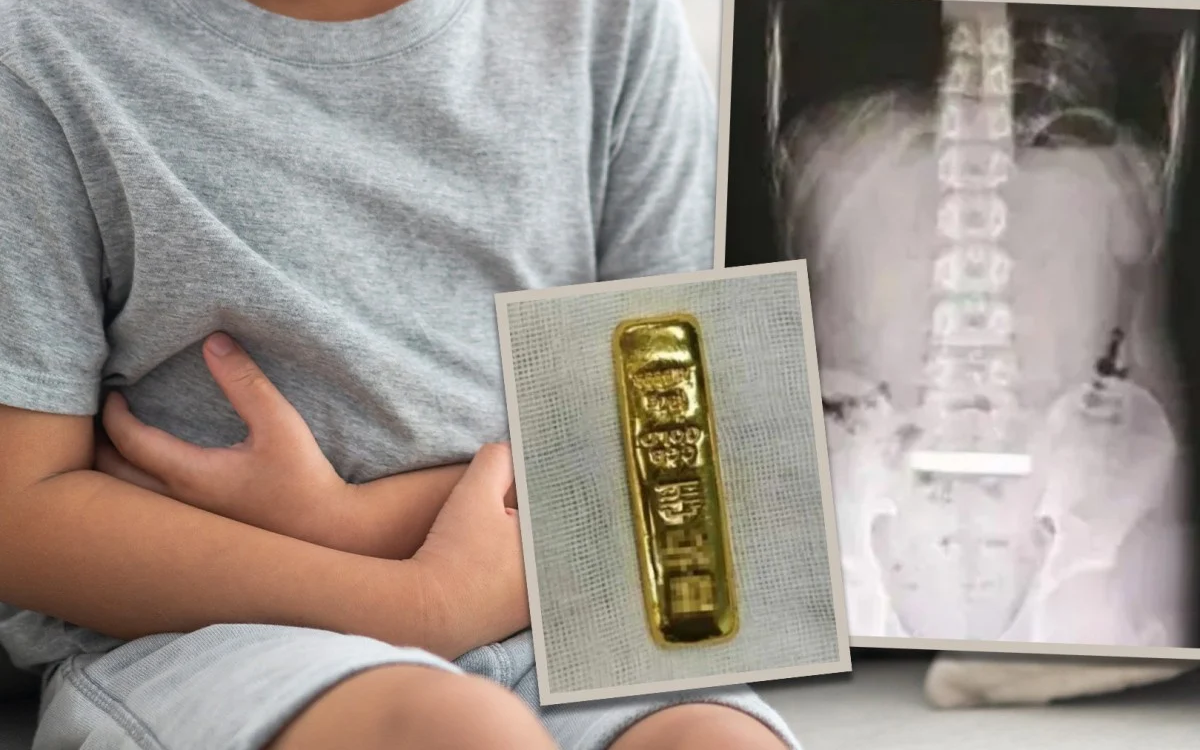Bé trai Trung Quốc nuốt thỏi vàng 100g, phải phẫu thuật để lấy ra