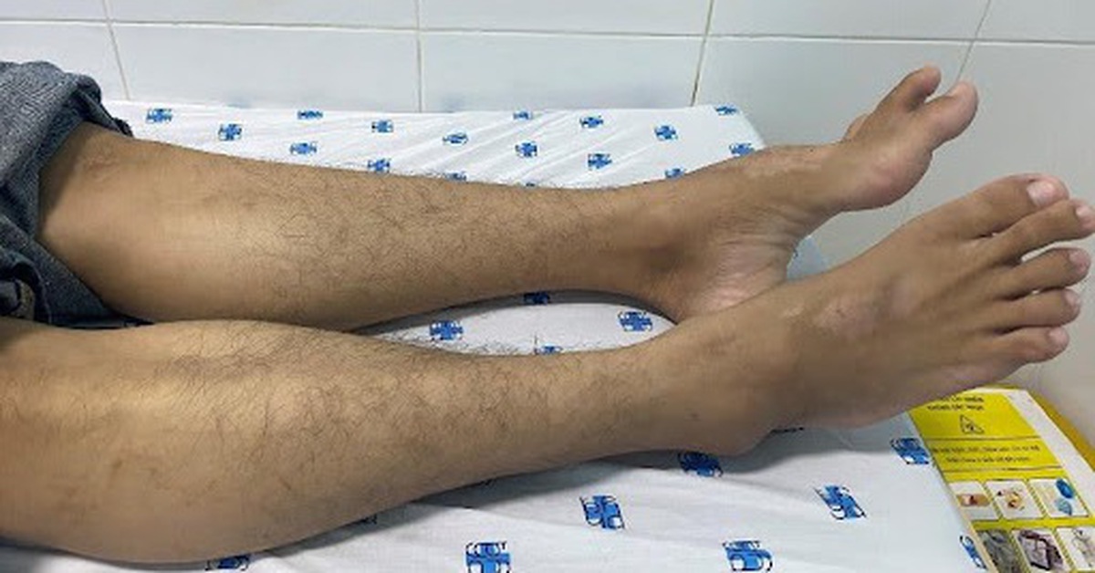Tê yếu chi dưới lâu ngày có thể là biểu hiện của bệnh hiếm?