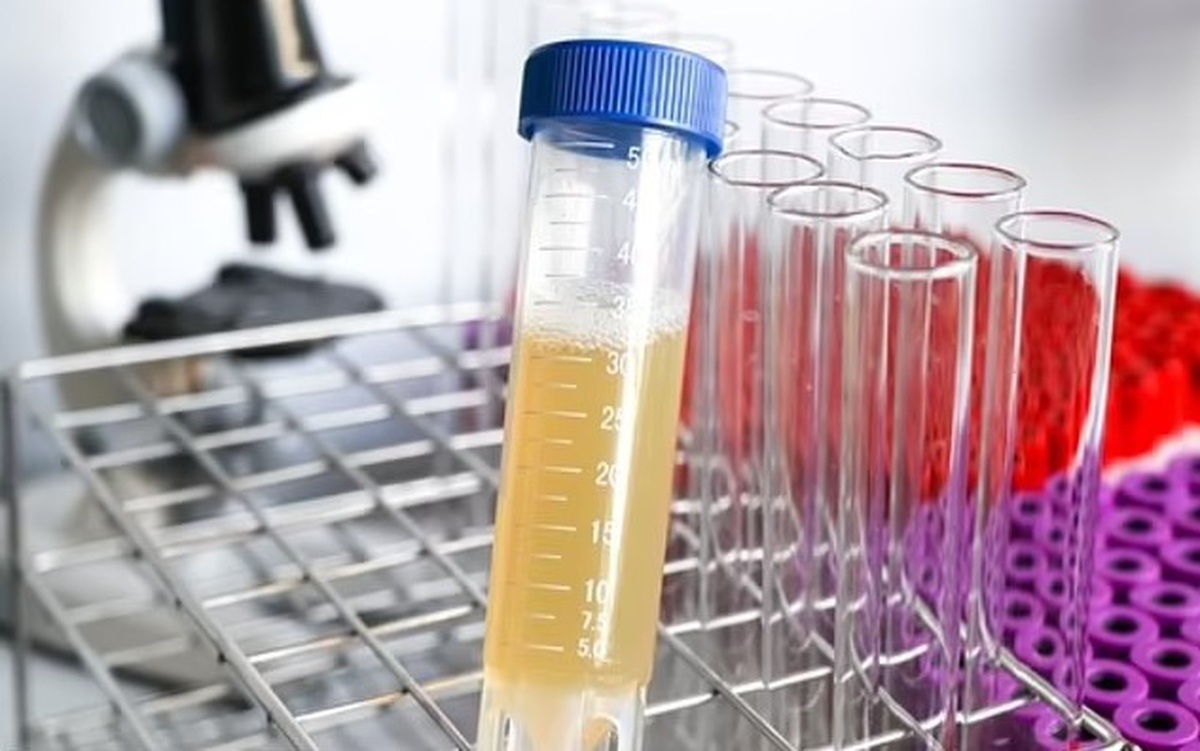 Nước tiểu có bọt có phải là dấu hiệu của bệnh lý?