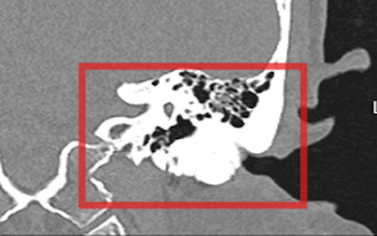 Giảm thính lực do lồi xương ống tai ngoài hiếm gặp