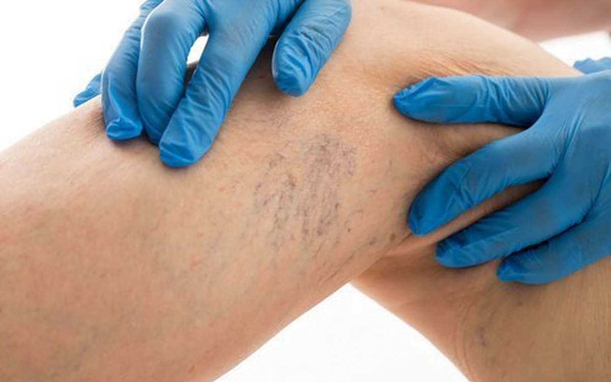 Nhân viên y tế dễ mắc suy giãn tĩnh mạch