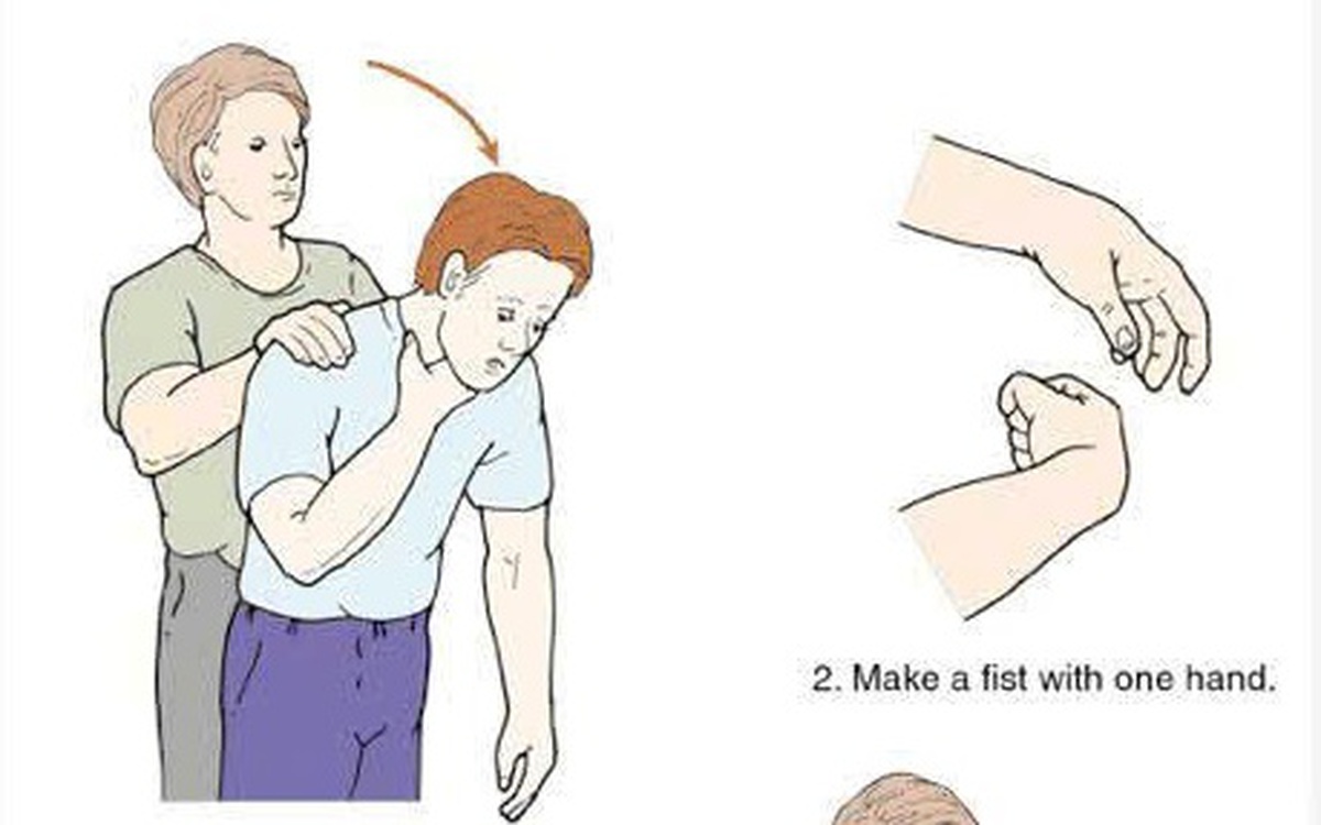 Cụ ông ngừng tim phổi vì hóc thịt bò khi ăn cỗ