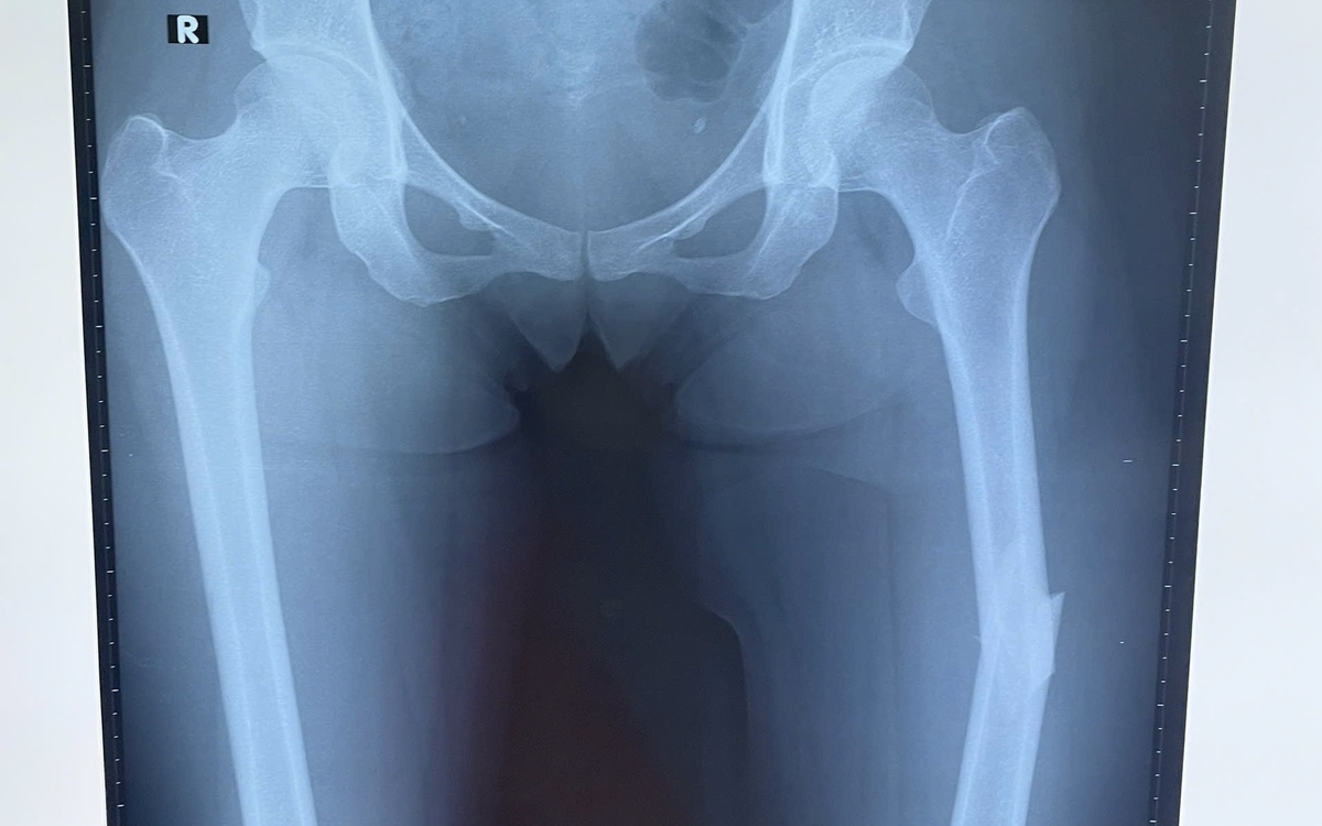 Từ việc một người mẫu bị gãy xương đùi khi chơi pickleball, bệnh viện khuyến cáo gì?