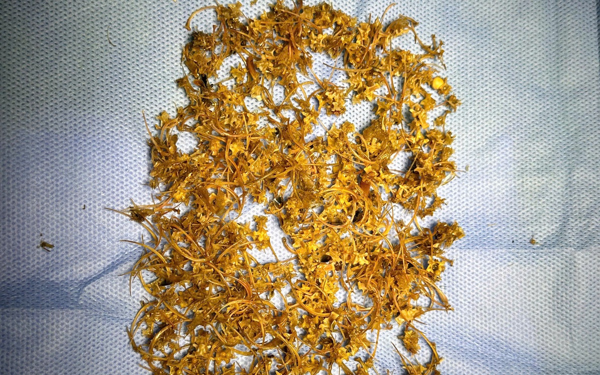 Tắc ruột vì dày đặc mảnh xương nhỏ sau khi ăn rắn bông súng hầm sả