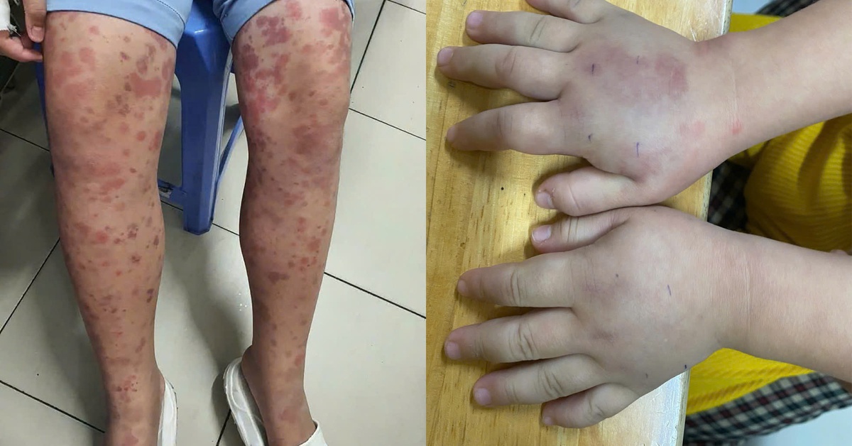 Cảnh báo bệnh ban xuất huyết Schonlein - Henoch gây biến chứng thận nguy hiểm ở trẻ em