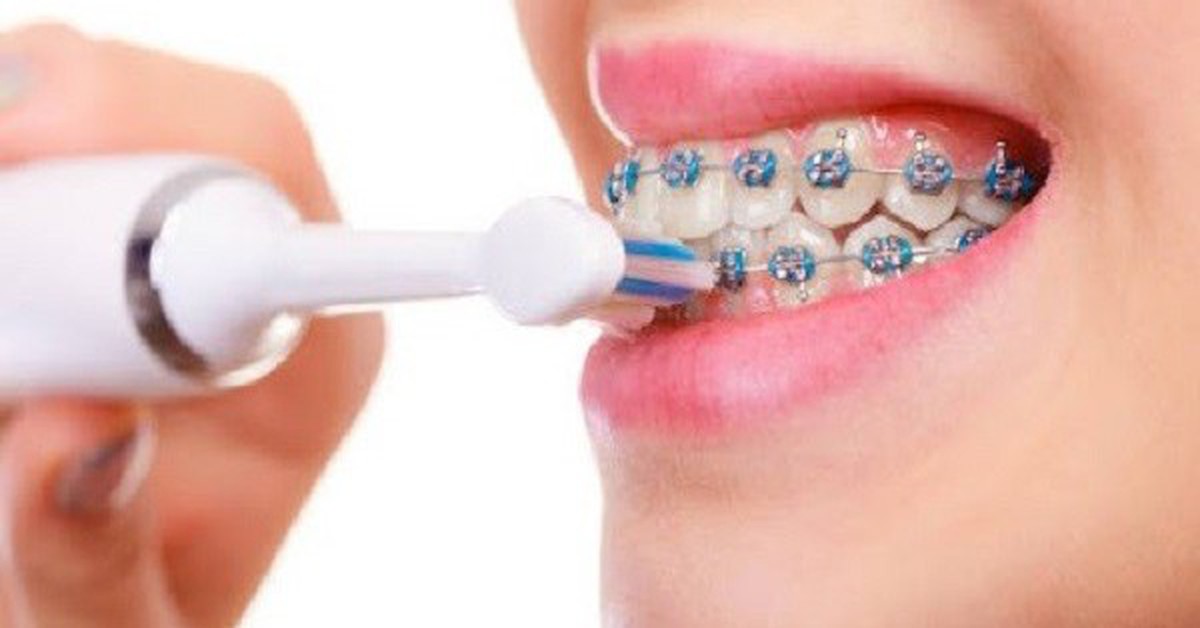 Ăn gì, vệ sinh răng thế nào khi đang niềng răng?