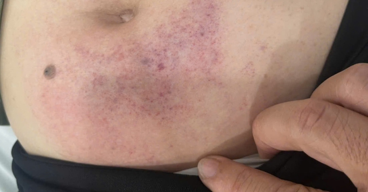 Xác minh vụ cô giáo lớp lá đánh hiệu phó trường mầm non đến nằm viện