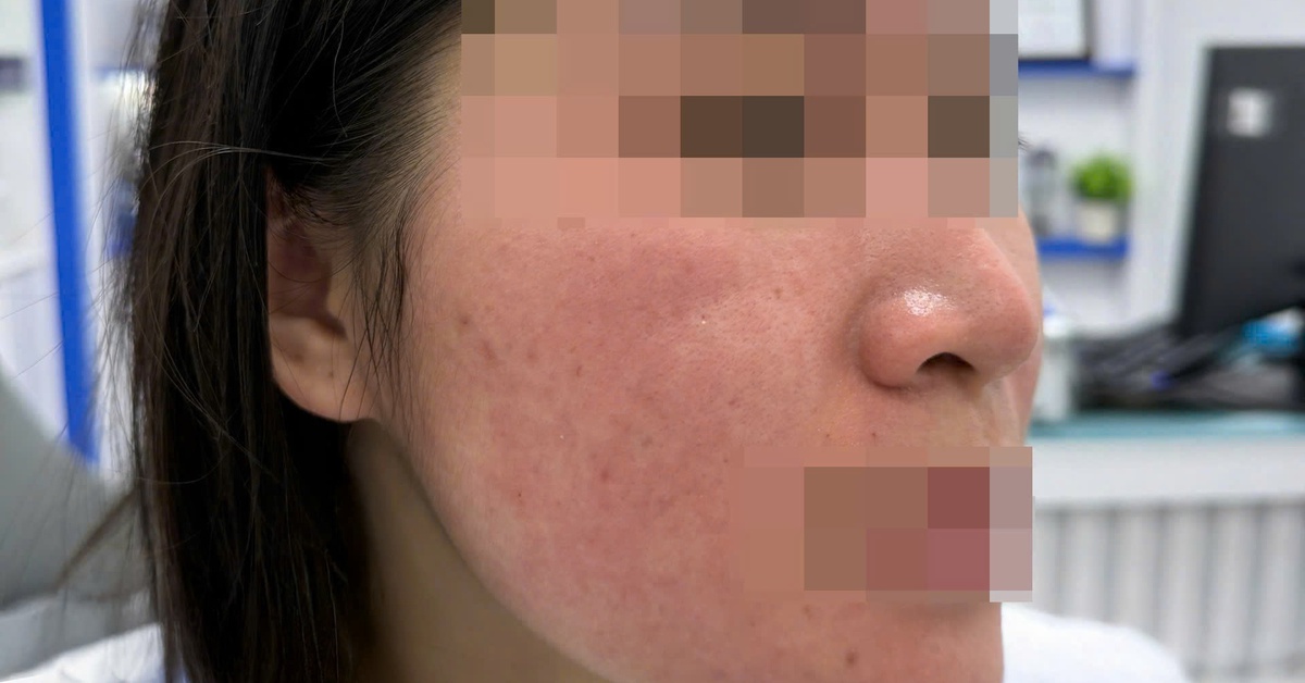 Hết trị bách bệnh, lại rước họa vì dùng nước cốt chanh trị mụn