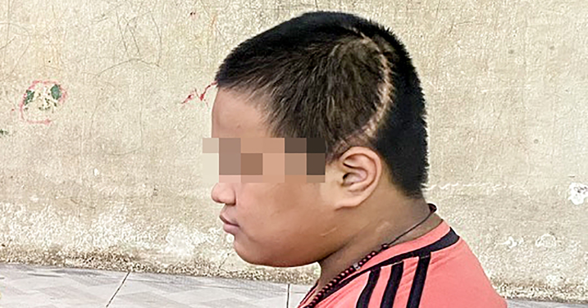 Vụ học sinh lớp 3 bị tông chấn thương sọ não: Ai chịu trách nhiệm bồi thường?