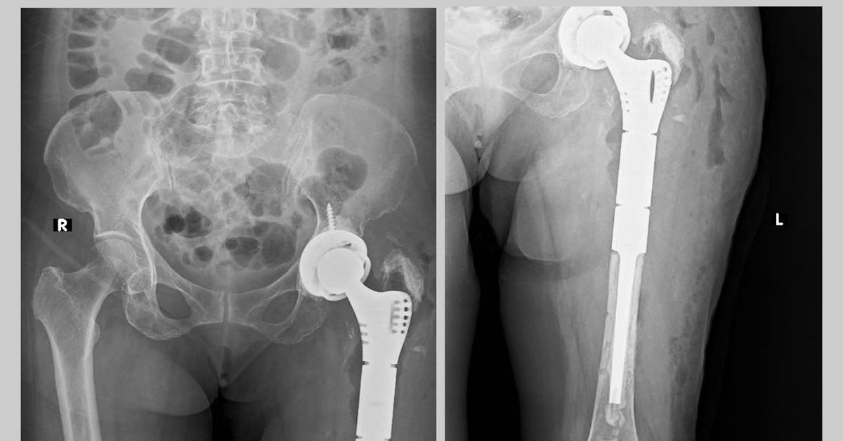 Lần đầu tiên tại miền Trung: Bệnh nhân được thay khớp háng và xương đùi nhân tạo