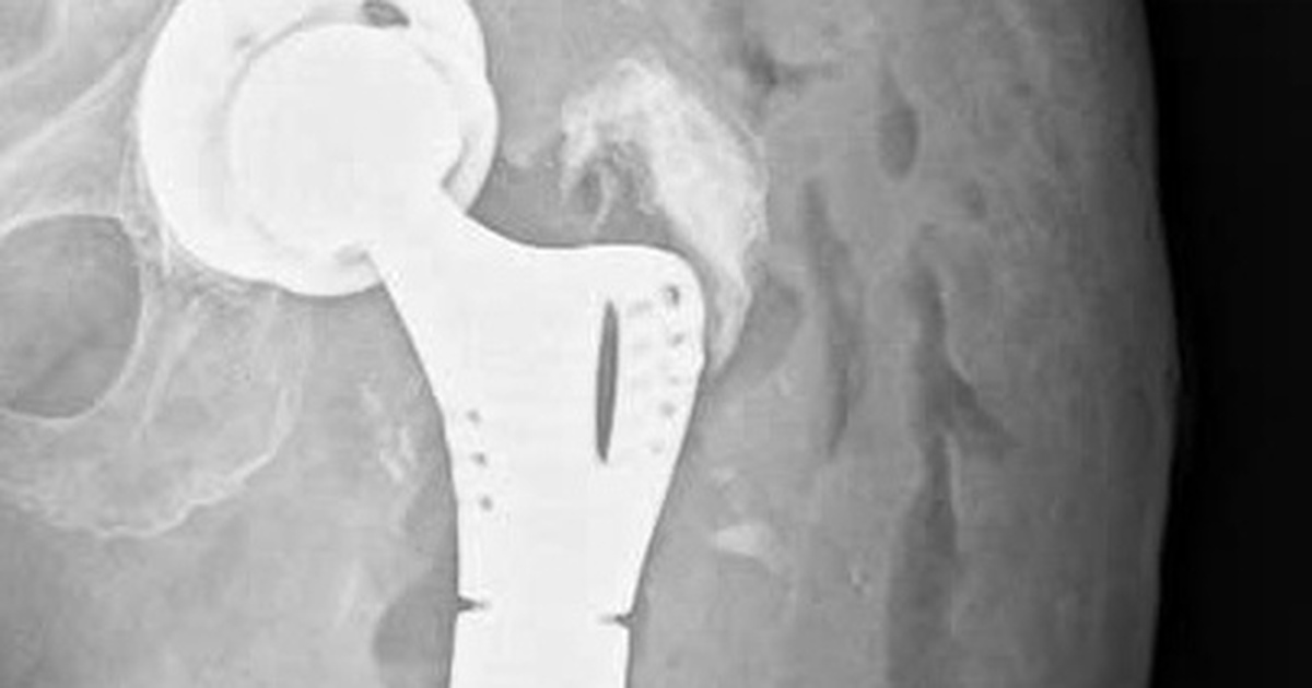 Lần đầu tiên tại miền Trung: Bệnh nhân được thay khớp háng và xương đùi nhân tạo
