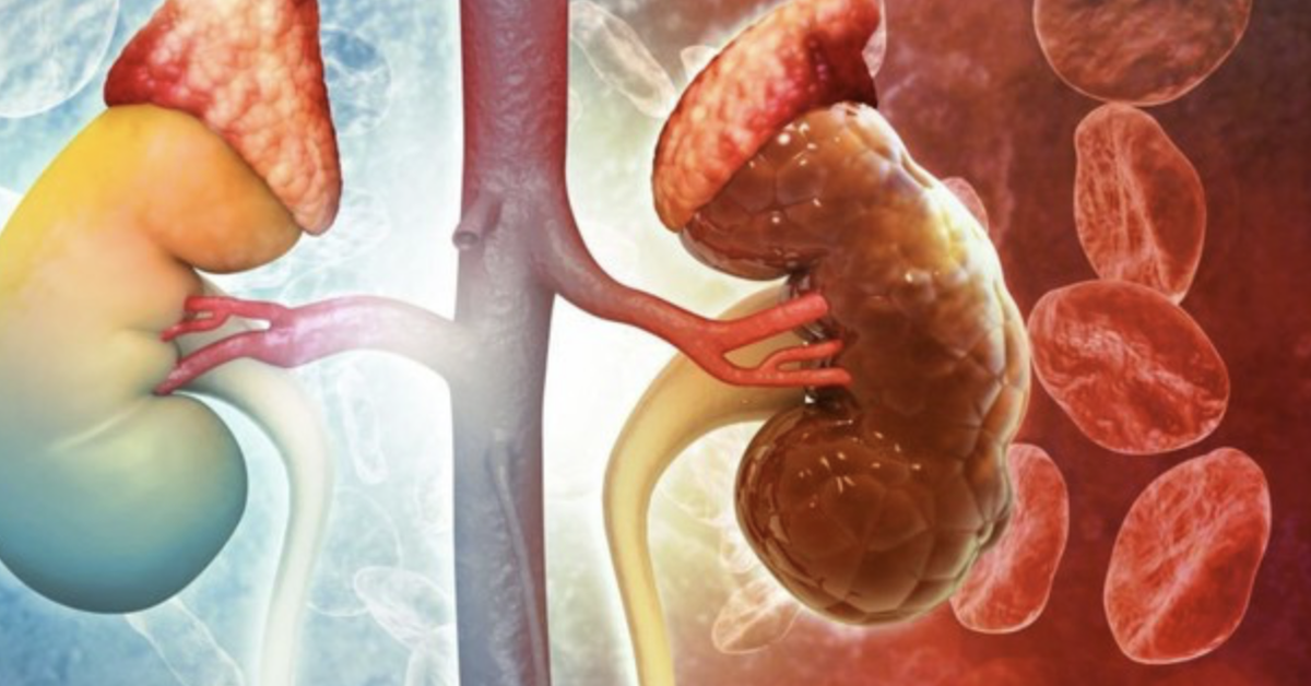 18 tuổi đã bị hỏng thận vì thói quen ăn uống