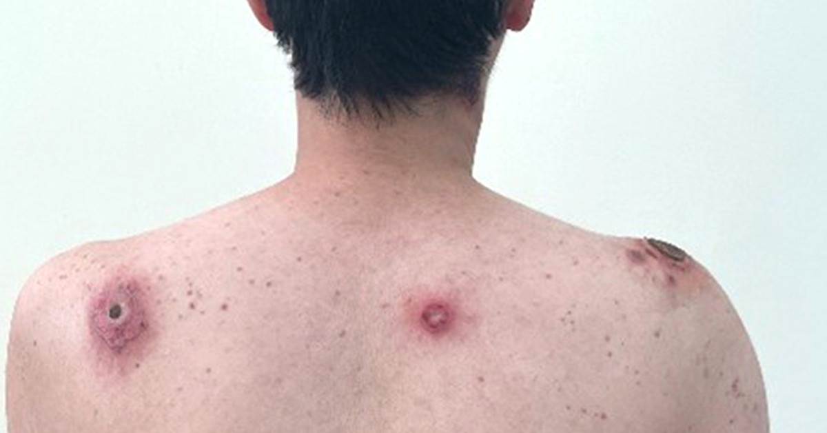 Vết loét tự lành: Dấu hiệu cảnh báo bệnh giang mai?