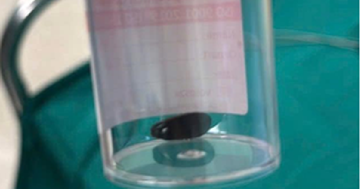 Bé Campuchia bị hóc hạt mãng cầu 20 ngày, được bác sĩ Việt Nam cứu kịp thời