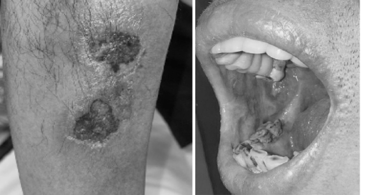 Uống sai liều thuốc da liễu, nhiều người ngộ độc nặng