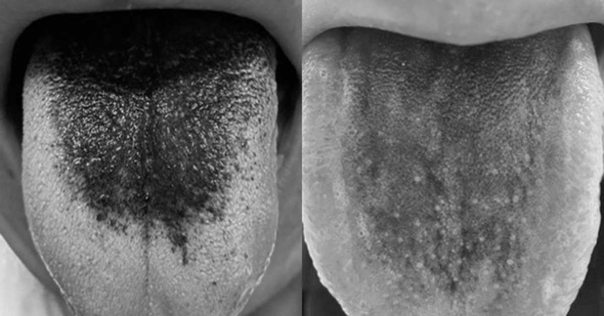 Lưỡi đen bất thường có phải bệnh nguy hiểm?