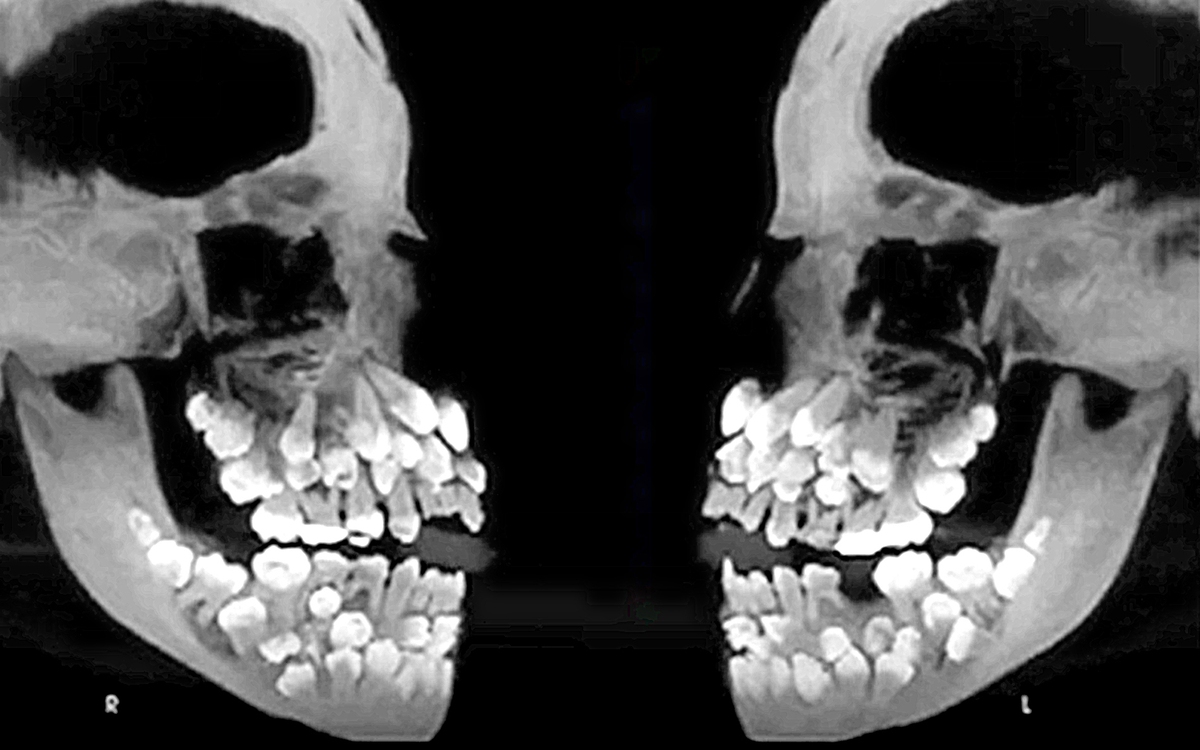 Ảnh X-quang cho thấy một người có 81 cái răng là thật